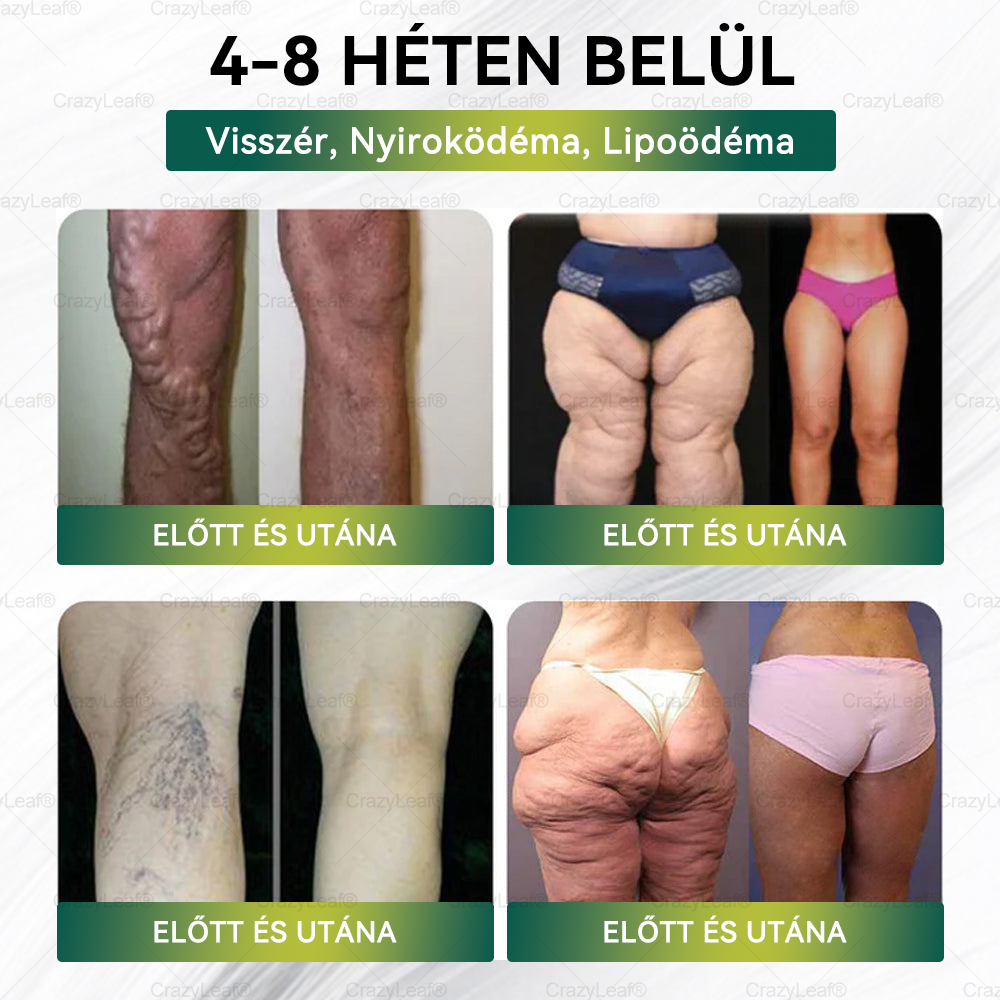 │Hivatalos webáruház│🌿 CrazyLeaf® SMGT-GLP-1 Nano Mikrotűs Tapasz 👉Természetes segítség túlsúly, fáradtság, bőr- és ízületi problémák ellen.