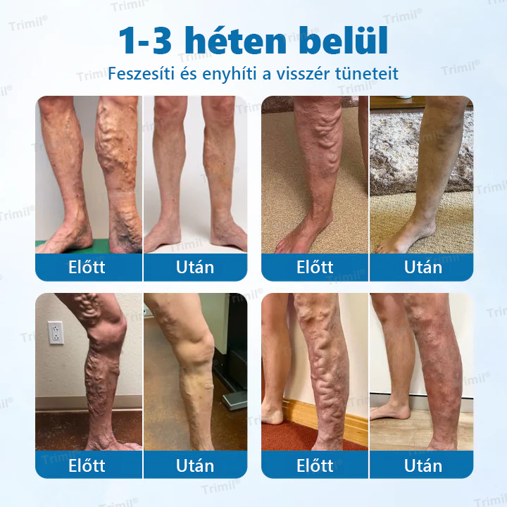 Trimil® VeinGuard Gyógynövényes Spray — 🎯Klinikailag bizonyított, hogy mindössze 7 nap alatt megszünteti a visszereket!